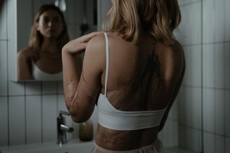 A woman with scars on her body
